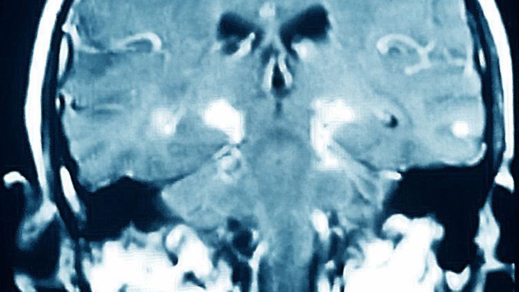 Das Gehirn eines Parkinson-Patienten.