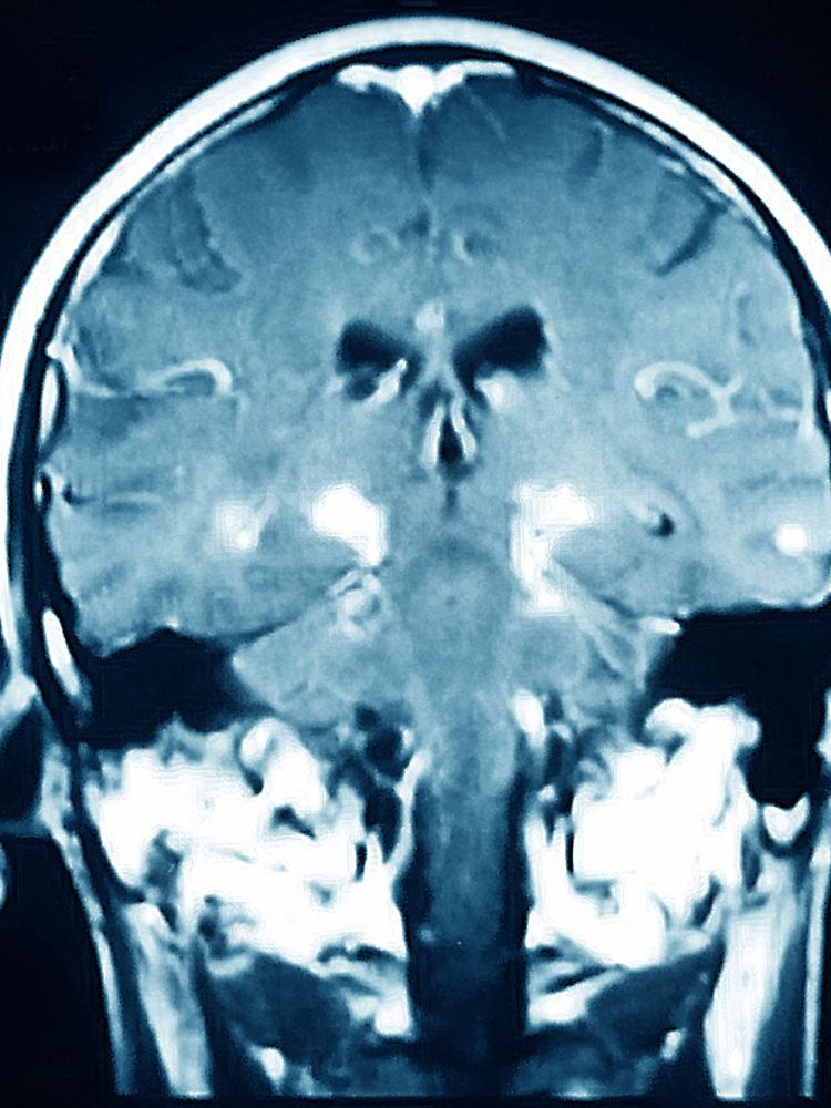 Magnetresonanzbild (MRT) der Parkinson-Krankheit, einer degenerativen Störung des zentralen Nervensystems.