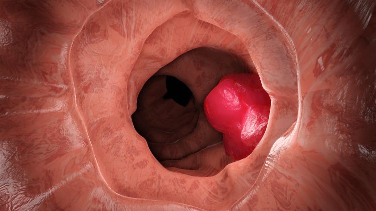 Tumor im Dickdarm.