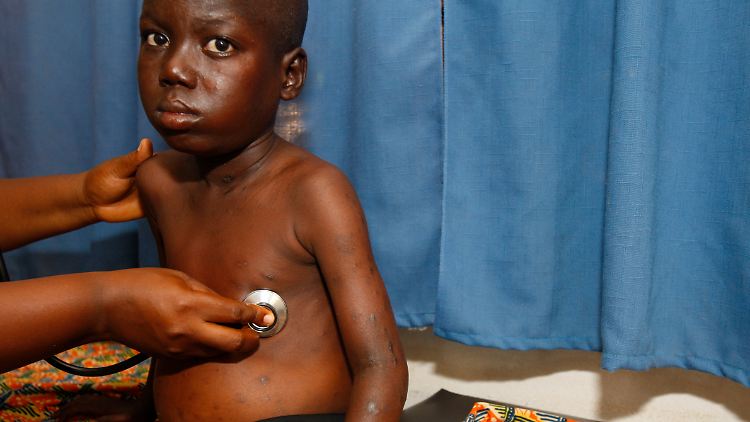 2022 waren nach UNAIDS-Schätzungen 39 Millionen Menschen weltweit mit HIV infiziert.