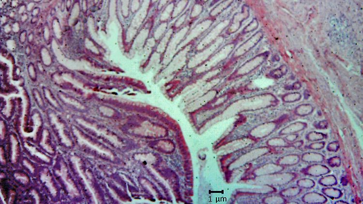 Das Bild zeigt den histologischer Schnitt durch Gewebe eines Dickdarm-Karzinoms.