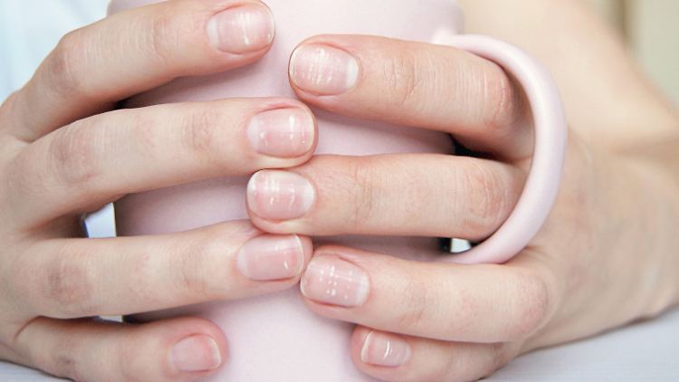 Weißliche Pünktchen auf der Nagelplatte? Meist harmlos, manchmal jedoch liegt ein Kalzium-Mangel vor, meint die Hautärztin.