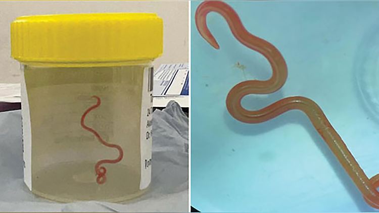 Ophidascaris robertsi, so der Name des Wurms, der im Gehirn einer Frau gefunden wurde.