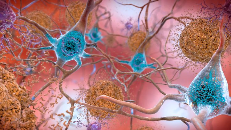Zellen in einem an Alzheimer erkrankten Gehirn.