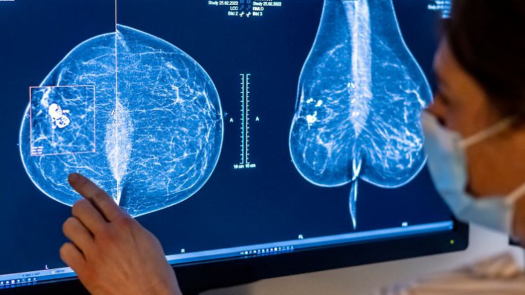 Jährlich gibt es rund 70.000 Brustkrebs-Neuerkrankungen in Deutschland. 