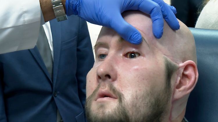 Patient Aaron James sagte im Oktober, dass sich das Auge gut anfühle. "Ich kann noch nicht blinzeln, aber ich fühle dort etwas." 
