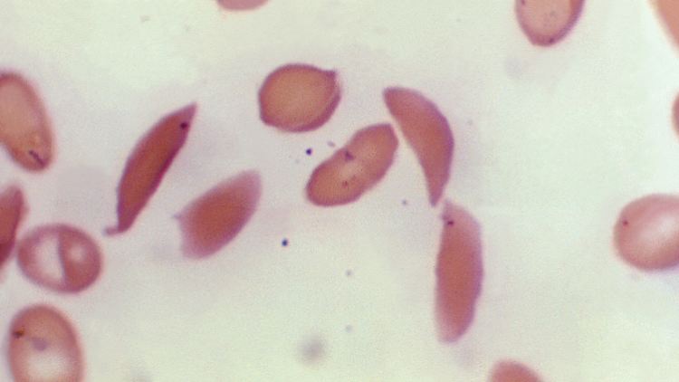 Das vom Center for Disease Control and Prevention (CDC) zur Verfügung gestellte Mikroskopfoto zeigt halbmondförmige rote Blutkörperchen eines an Sichelzellenanämie erkrankten Patienten aus dem Jahr 1972. 
