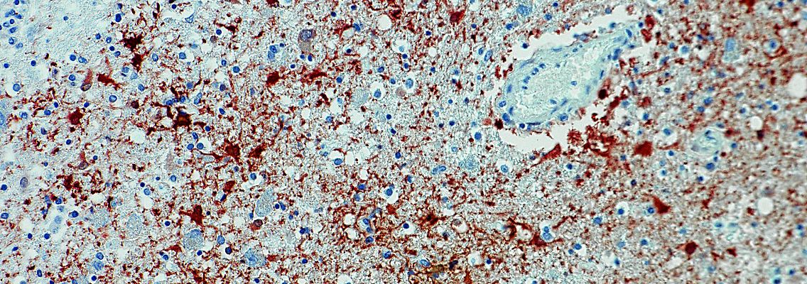 Die undatierte Aufnahme zeigt einen Anitkörpernachweis zum Borna-Virus im Gewebe.