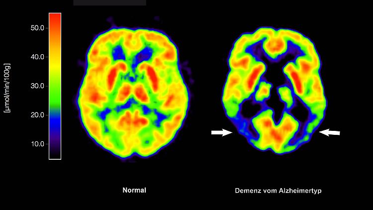 Ist Demenz erst einmal fortgeschritten, steht es um die Behandlungserfolge schlecht.
