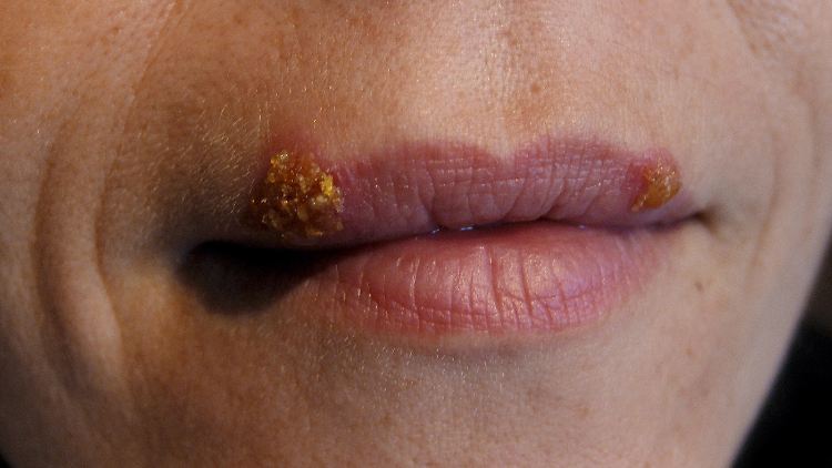 Bis zu 90 Prozent aller Menschen tragen Herpesviren in sich.