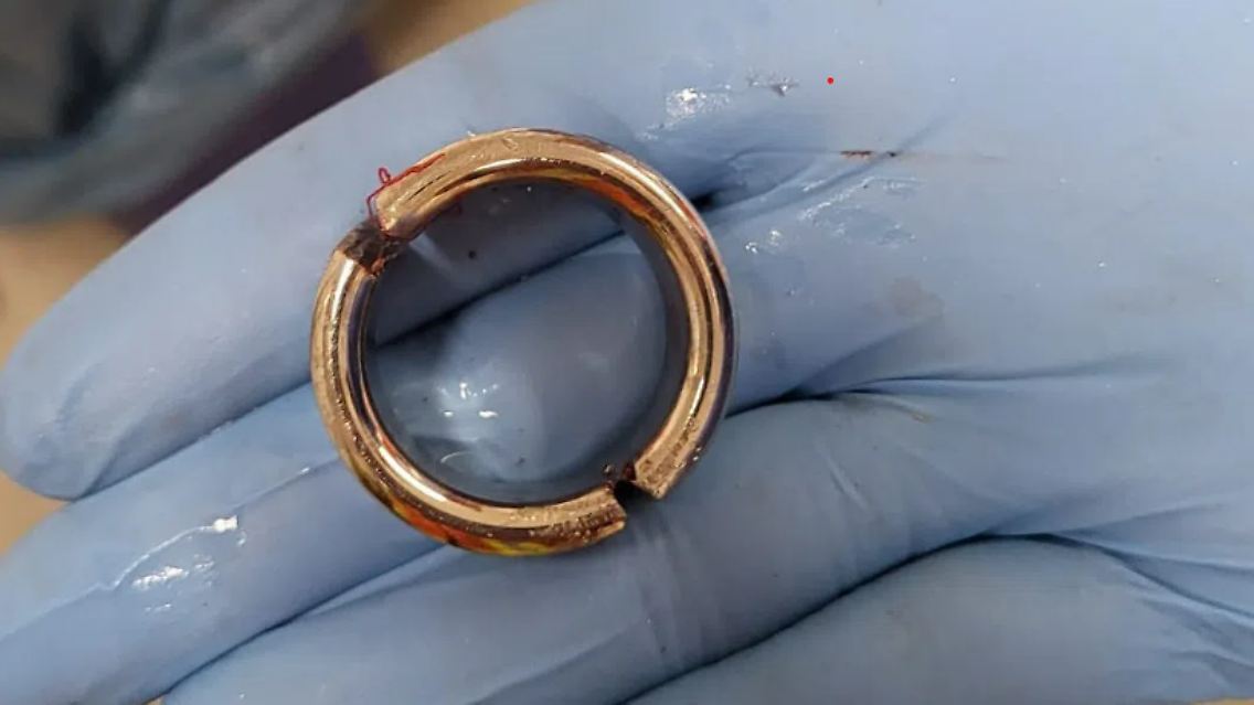 Anderthalb Stunden dauerte die Befreiung von dem Ring.