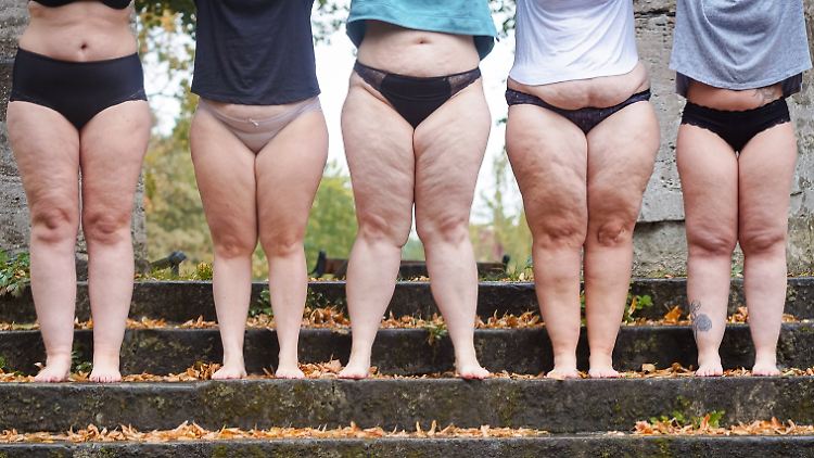 Es wird geschätzt, dass in Deutschland bis zu vier Millionen Frauen vom Lipödem betroffen sind, sehr viele das aber nicht wissen.