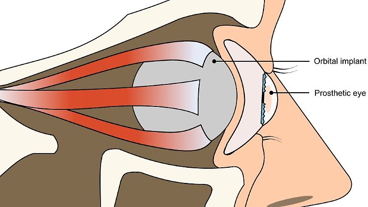 Die Augenprothese sitzt zwischen den Augenlidern und dem Implantat.