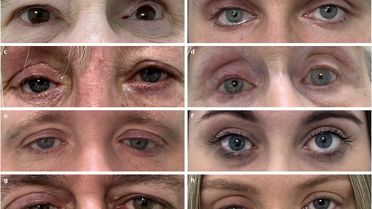 Patientinnen und Patienten bewerteten ihre künstlichen Augen aus dem 3D-Drucker durchgängig als gut bis sehr gut. (Bild a und e: Prothese rechts. Bild b, c, d, f, g und h: Prothese links)