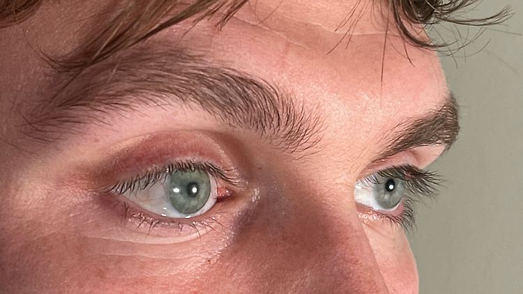 Die Prothese für das rechte Auge ist kaum vom echten linken Auge zu unterscheiden.