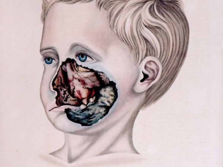 Pathologisch-anatomische Zeichnung von Robert Froriep von 1836: Damals war Noma auch noch in Europa verbreitet.