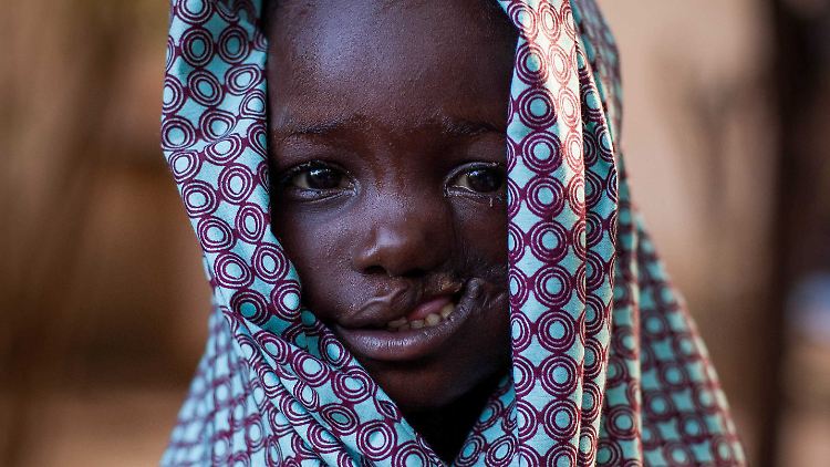 Jedes Jahr erkranken schätzungsweise 140.000 Kinder an Noma - und nur etwa 10 Prozent von ihnen überleben.