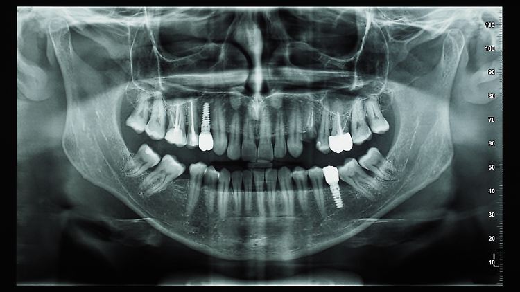 Hier sitzen Implantate und Schrauben normal. Zum Vergleich die Bilder unten.