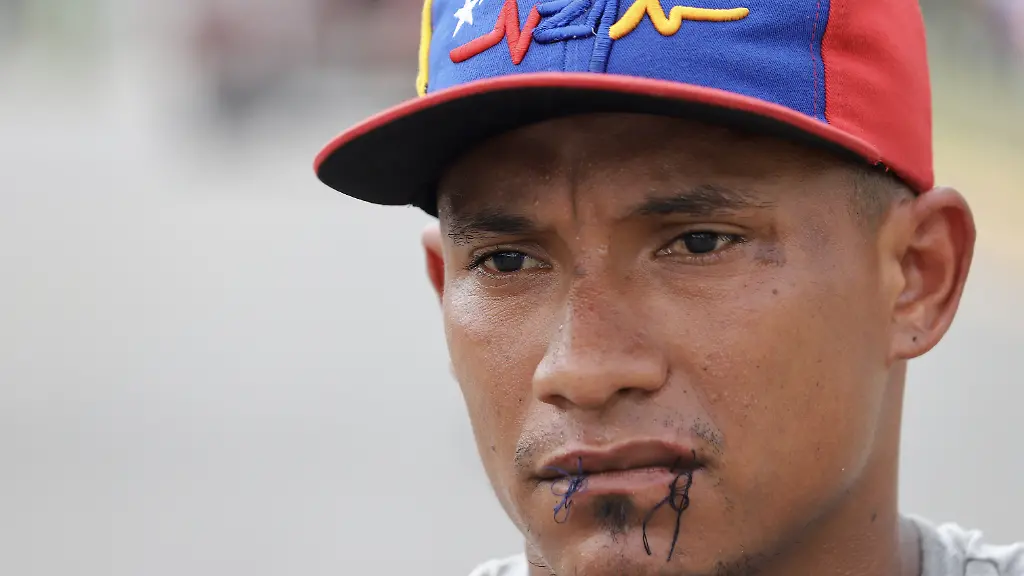 Zugenaehte-Lippen-aus-Protest-gegen-die-Migrationspolitik