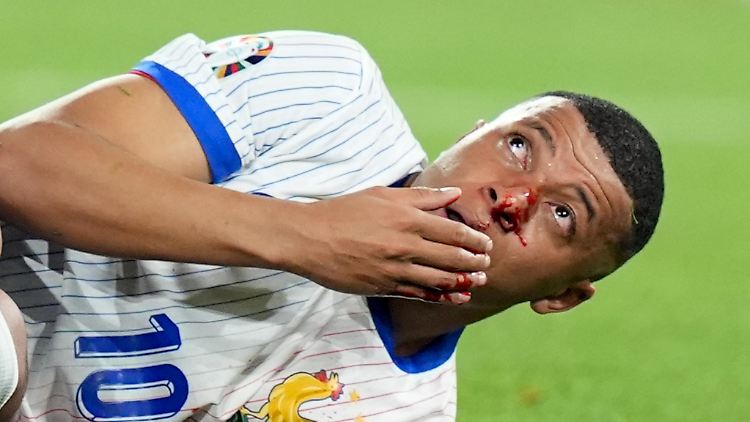 Blutiger EM-Auftakt für Frankreichs Stürmer Mbappé. 