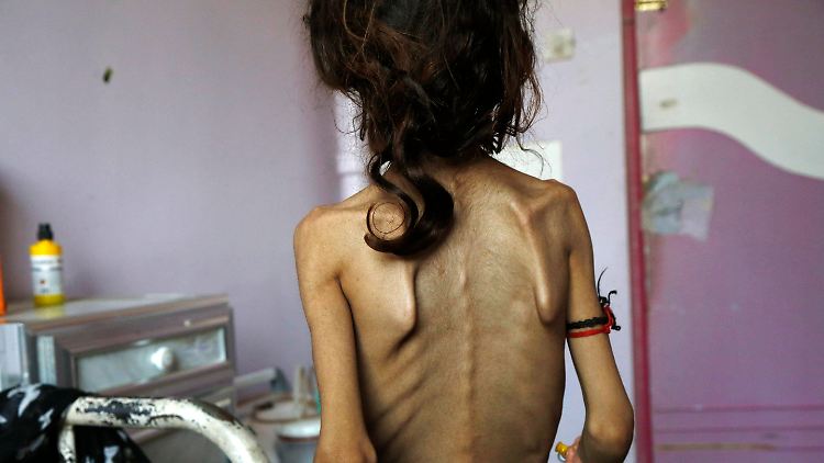 Millionen Kinder sind unterernährt und ausgezehrt.