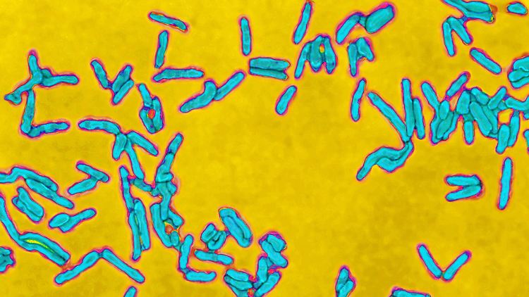 Ausgelöst wird Diphtherie durch Bakterien (vor allem Corynebacterium diphtheriae), die weltweit verbreitet sind.