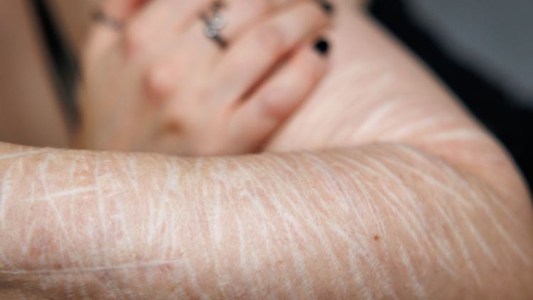 Die Narben auf dem Arm zeugen von tiefen Schnitten mit Rasierklingen, die sich die Frau selbst zugefügt hat.