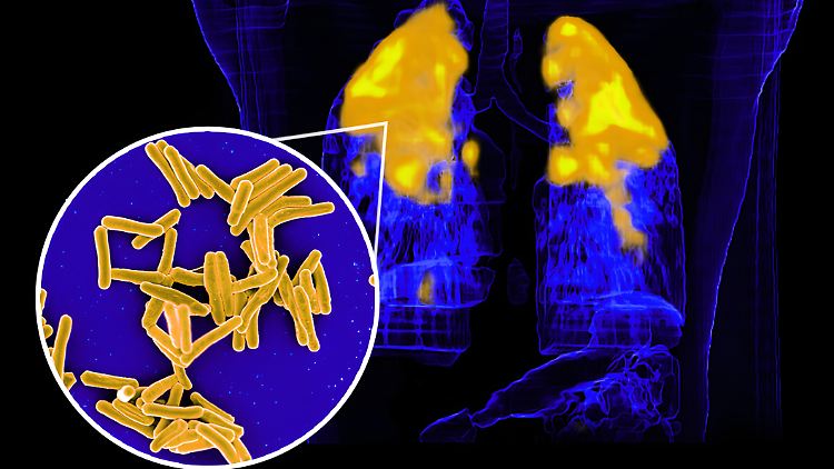 Aufnahmen von Mycobacterium-tuberculosis-Bakterien, die Tuberkulose (TB) verursachen, und einer TB-Infektion in der Lunge eines Patienten. 