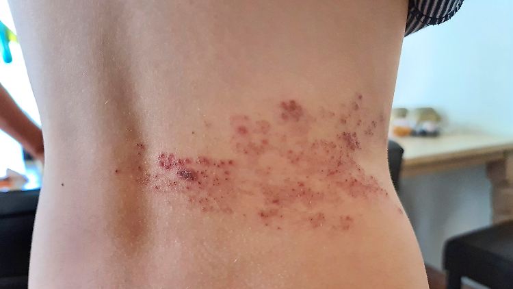 Hautbläschen und Juckreiz sind typische Symptome der Gürtelrose. Sie tritt meist nur einseitig auf.