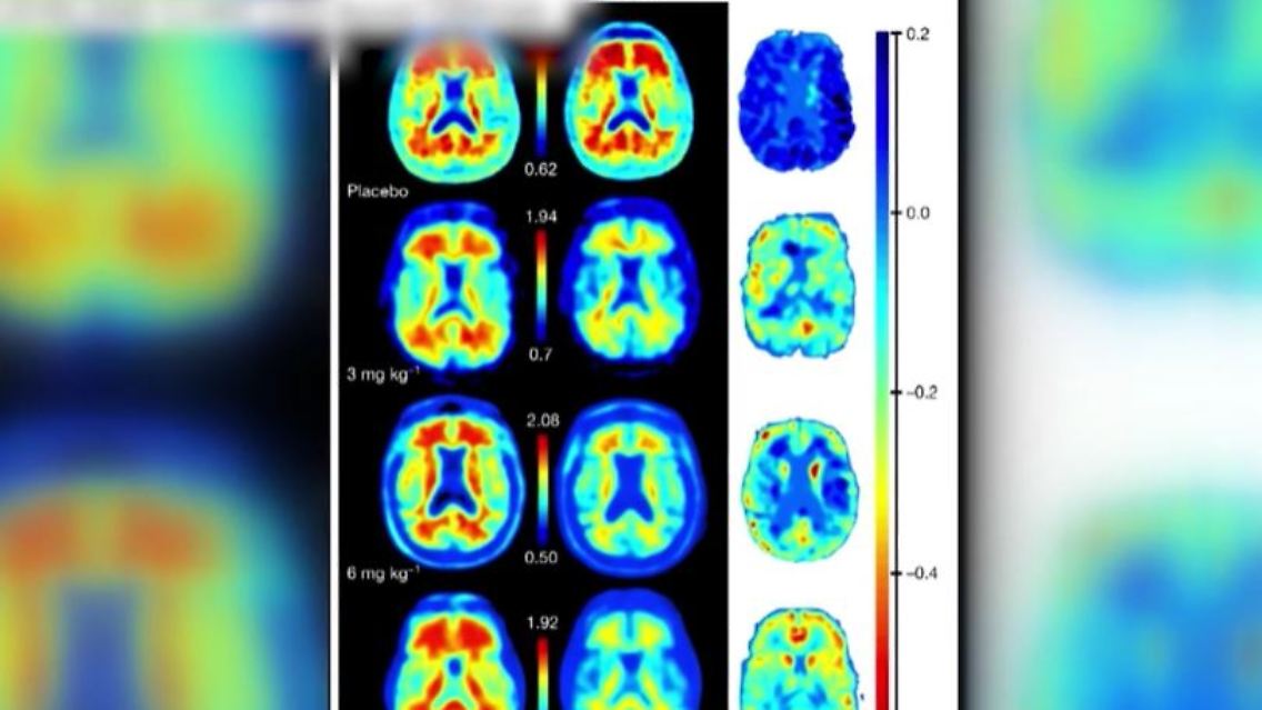 alzheimer.JPG