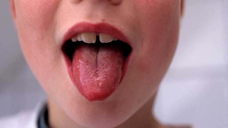 Scharlach ist eine durch das Streptokokken-Bakterium Streptococcus pyogenes hervorgerufene Infektionskrankheit.
