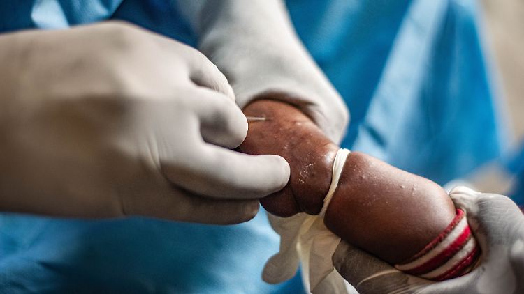 Der Kongo kämpft bereits gegen eine Mpox-Epidemie.