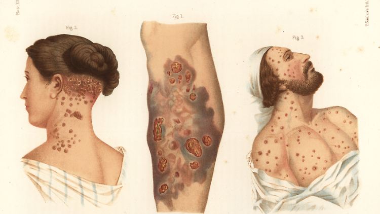 Verursacht wird Syphilis durch das Bakterium Treponema pallidum - hier eine Abbildung der Symptome aus dem "Atlas der Geschlechtskrankheiten" von 1868.