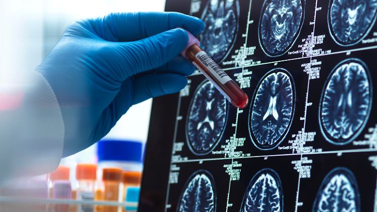 In den USA ist der Wirkstoff Lecanemab bereits seit Anfang 2023 zugelassen. 