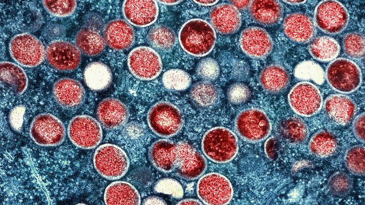 Die für Mpox typischen Pusteln können im Genital- oder Analbereich beginnen und manchmal auch im Mund auftreten.