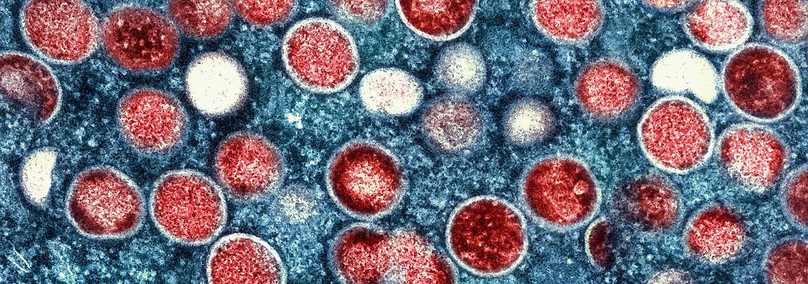Die für Mpox typischen Pusteln können im Genital- oder Analbereich beginnen und manchmal auch im Mund auftreten (Symbolbild).