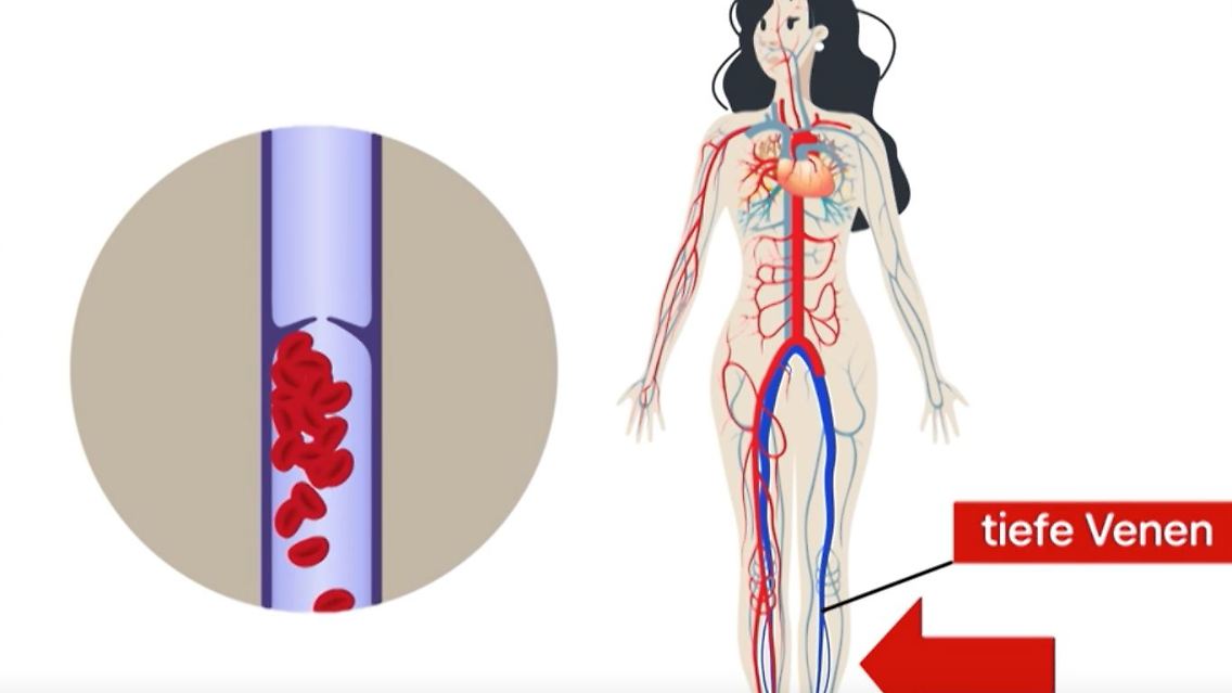 thrombose.JPG