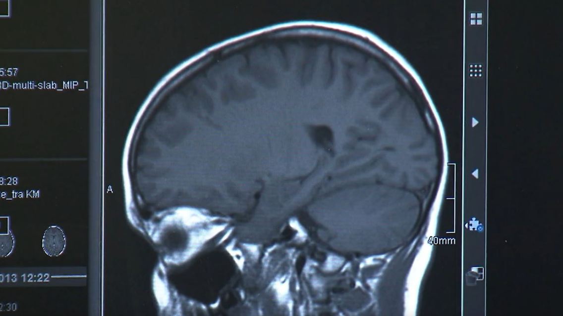 parkinson.JPG