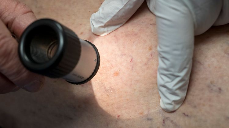 2023 wurden laut Destatis rund 4500 an Hautkrebs gestorbene Menschen erfasst. 