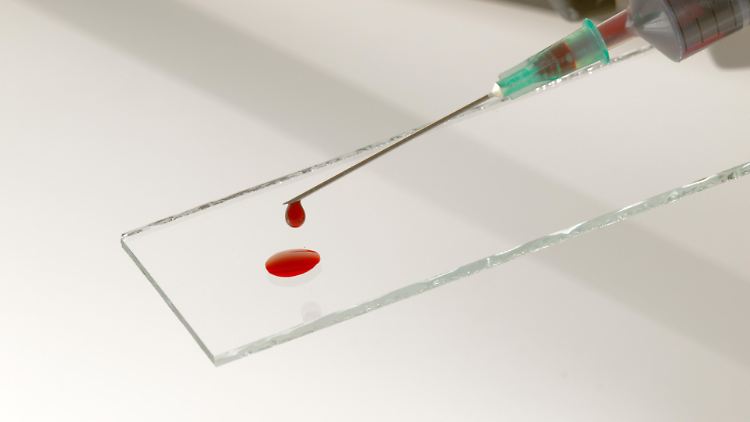 Der neue Bluttest trägt den komplizierten Namen "Lumipulse G pTau217/ß-Amyloid 1-42 Plasma Ratio".