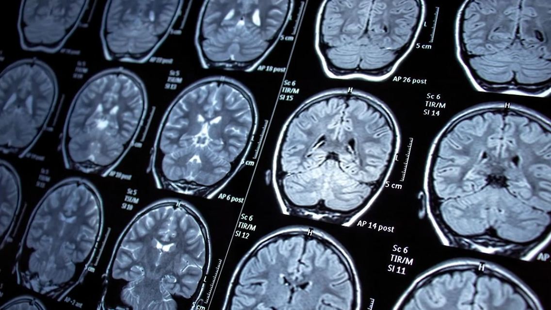 Hirntumor.jpg