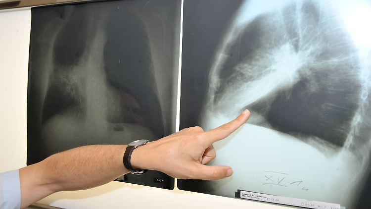 Bislang können Raucher nur eine CT-Untersuchung machen, wenn sie bereits Symptome haben. 