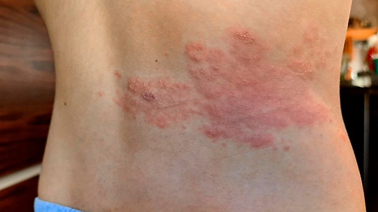 Juckt und tut weh: Gürtelrose am Rücken. Sie kann auch andere Körperteile befallen.