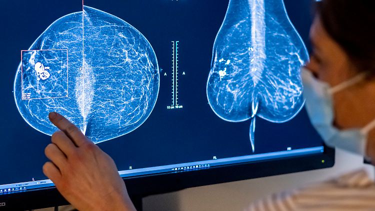 Mithilfe der Mammografie können auch Tumore erkannt werden, die noch klein und nicht tastbar sind.
