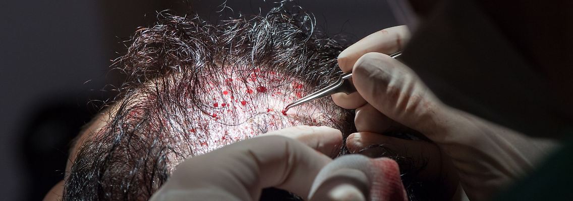 Unter bestimmten Voraussetzungen können die Kosten einer Haartransplantation steuerlich geltend gemacht werden.