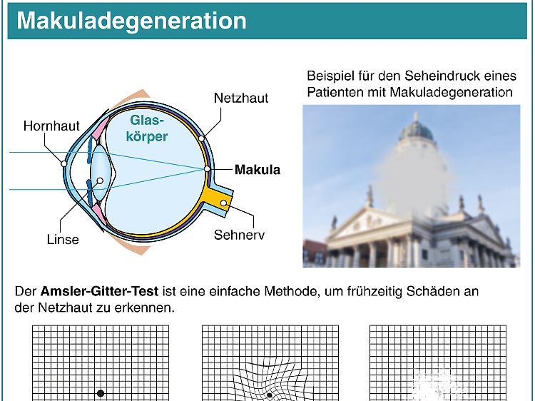 Die Makula ist ein sensibler Bereich der Netzhaut und für das scharfe Sehen verantwortlich.