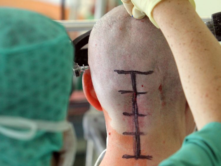 Ein Patient wird für eine operative Entfernung eines Hirntumors vorbereitet.
