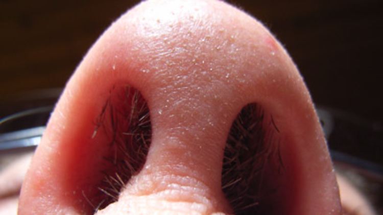 Ein bestimmter Herpes-Virus kann über die Nase bis ins Gehirn gelangen. 