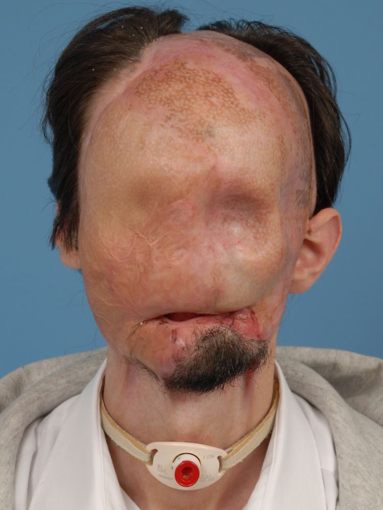 Bei einem Arbeitsunfall verlor er sein komplettes Gesicht.