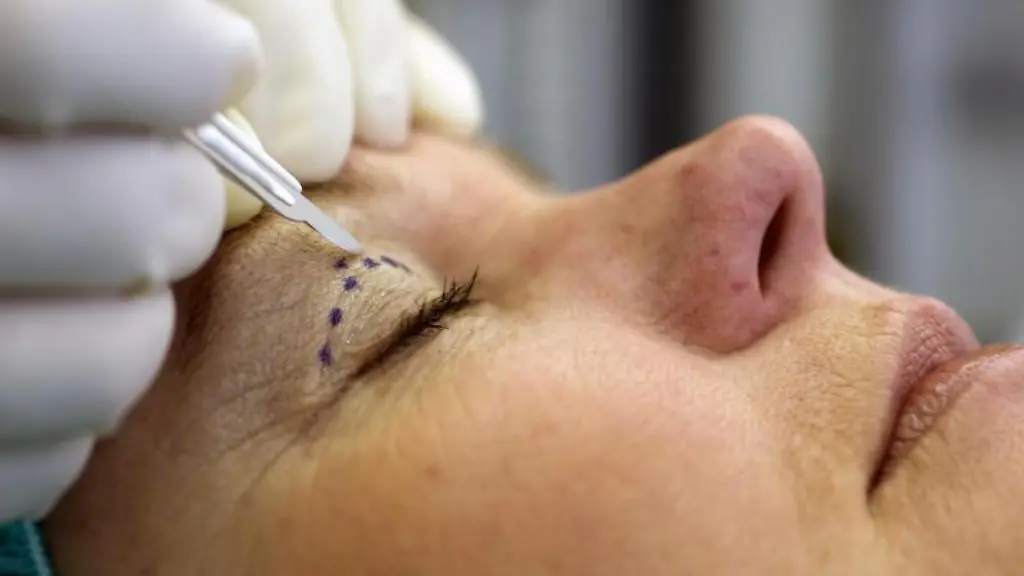 Eine-Frau-unterzieht-sich-einer-Augenlidstraffung